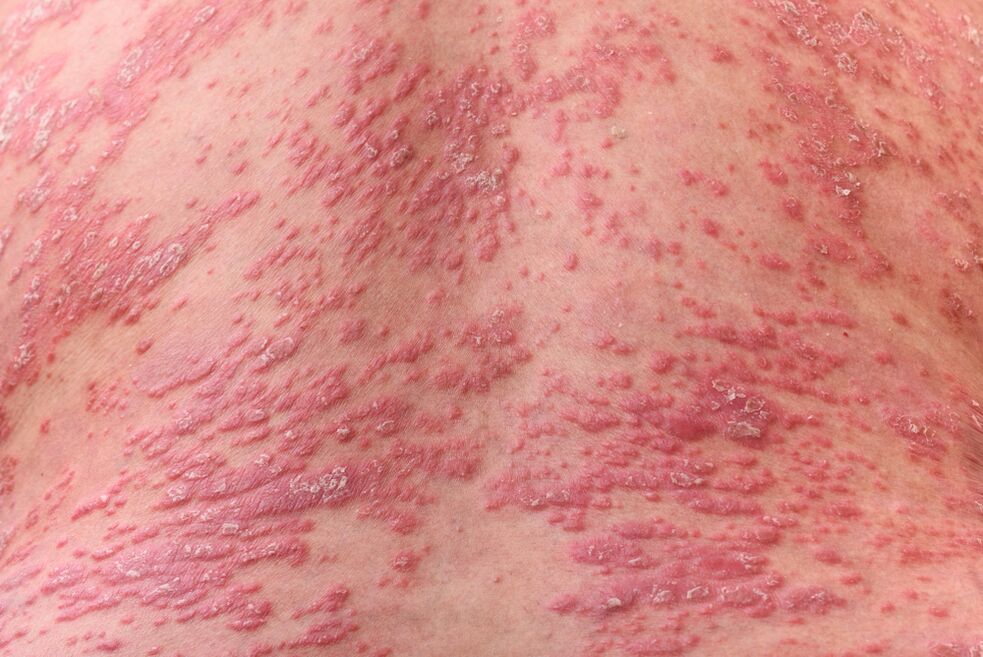 Wie sieht Psoriasis aus 