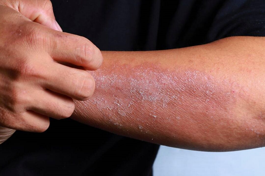 Psoriasis-Symptome